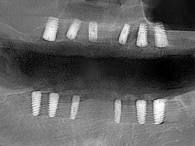 全牙列缺損修復病例